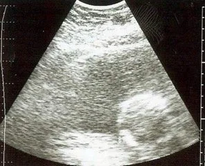 Our son, Ian, still in Cindy’s womb.